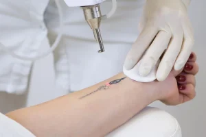 Read more about the article How Advanced Laser Technology Helps Fade Tattoos Safely