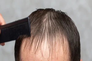Read more about the article How to Pick the Right Hair System for Your Daily Life