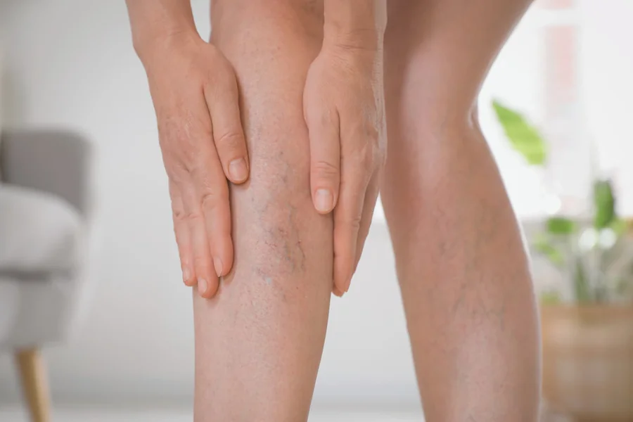 You are currently viewing Varicose Veins Treatment for Pain Relief and Comfort