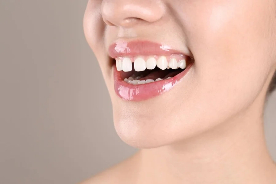 You are currently viewing From Gaps to Grins: Restoring Confidence in Your Smile
