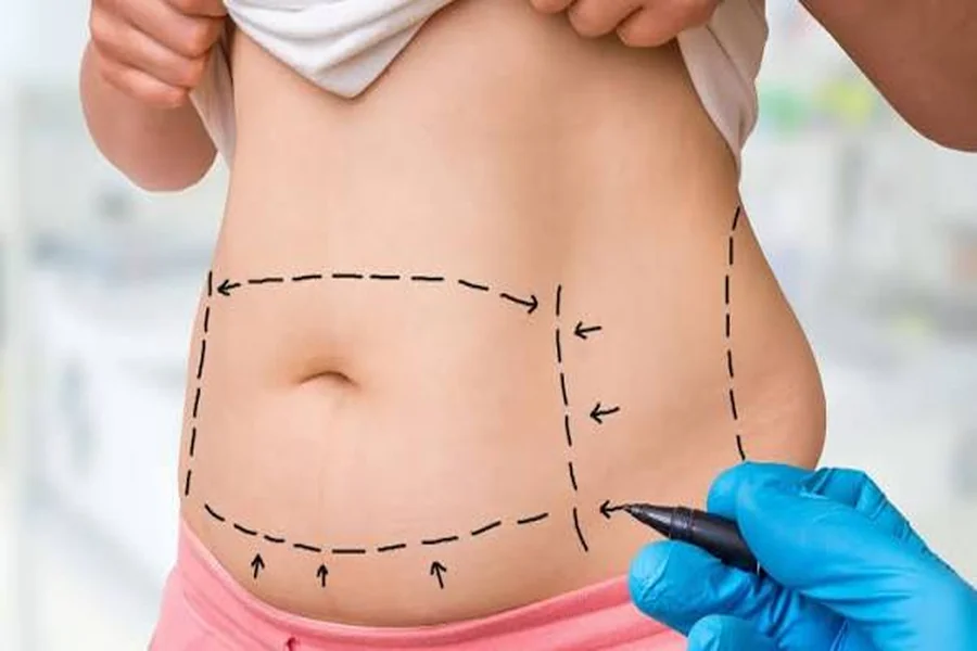 You are currently viewing How to Prepare for Abdominoplasty Surgery and Recovery